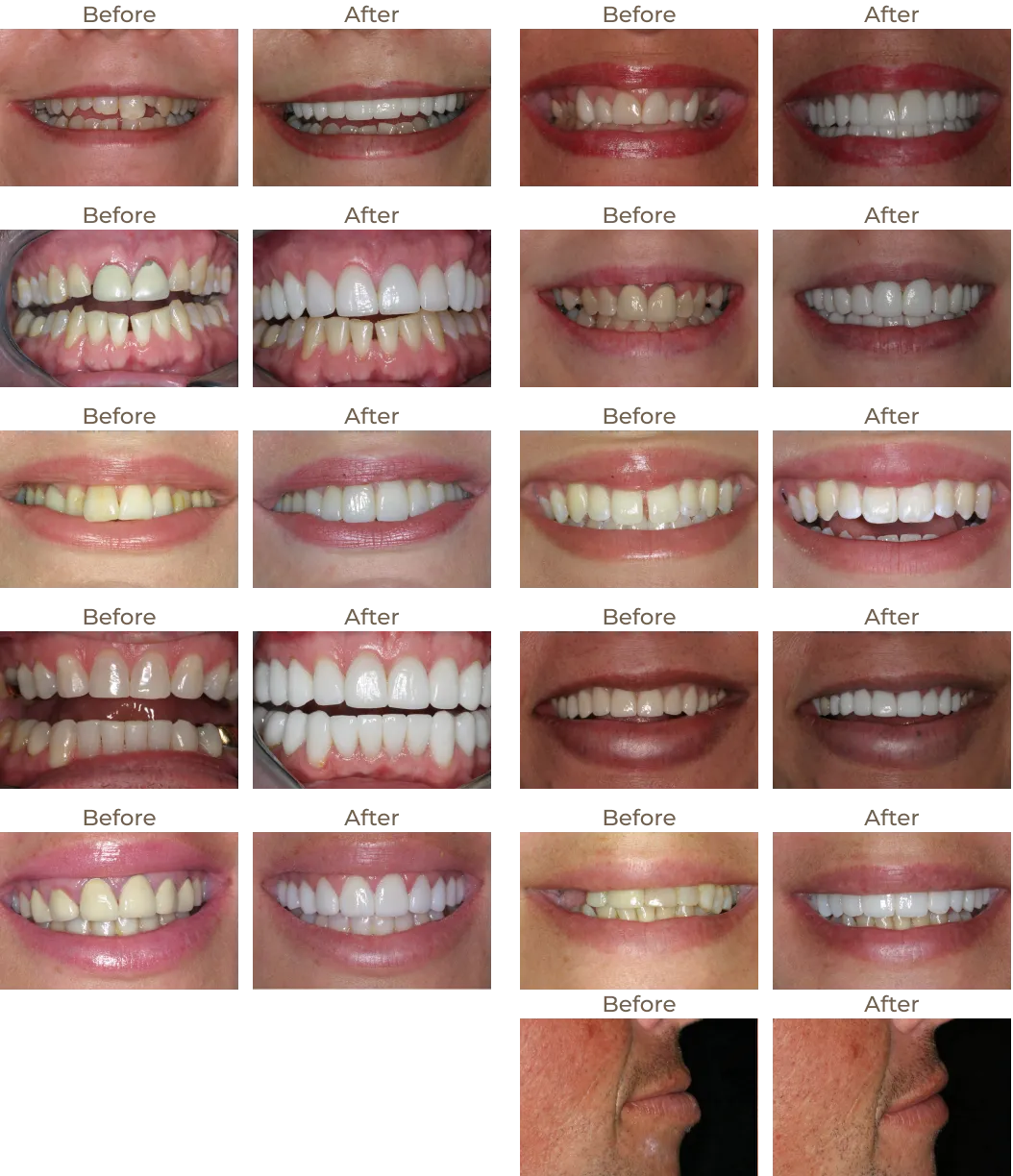 Before and after photos of teeth