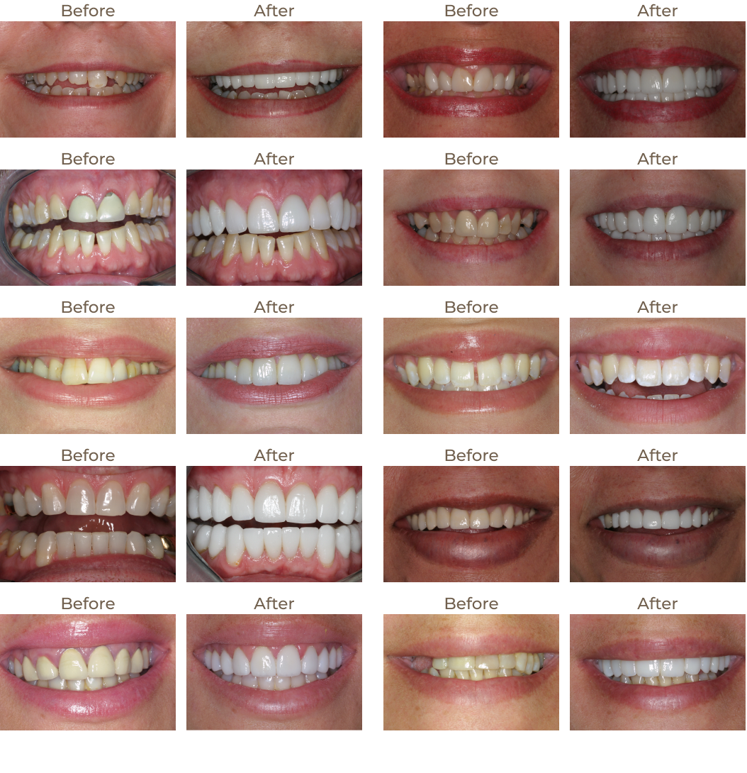 Before and after photos of teeth